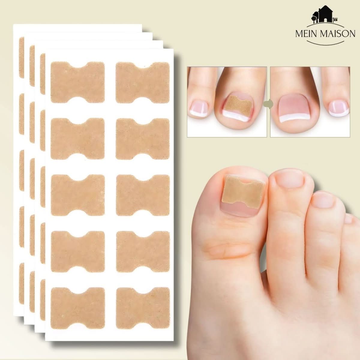 BowLift | Gentle nail correction against ingrown nails & pain