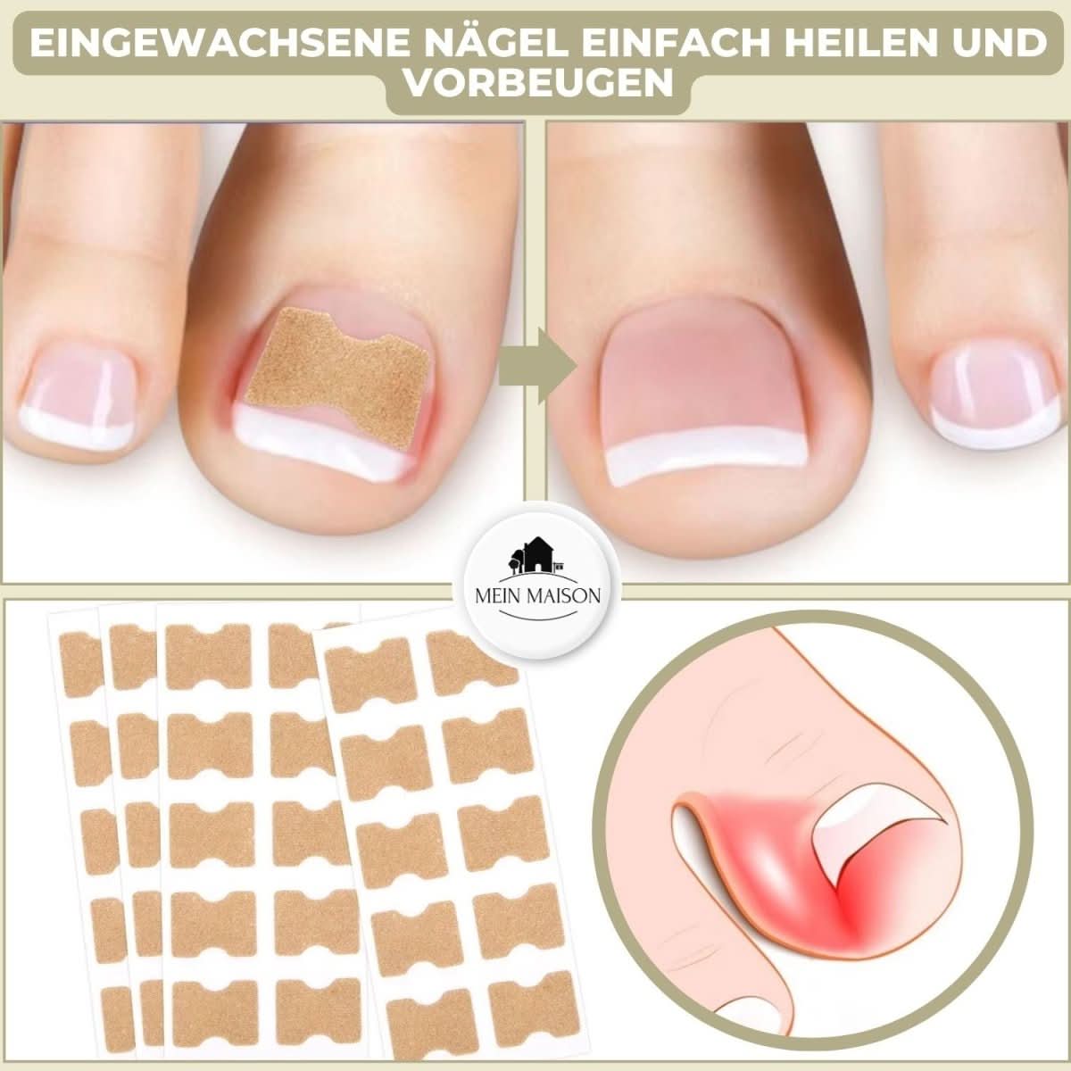 BowLift | Gentle nail correction against ingrown nails & pain