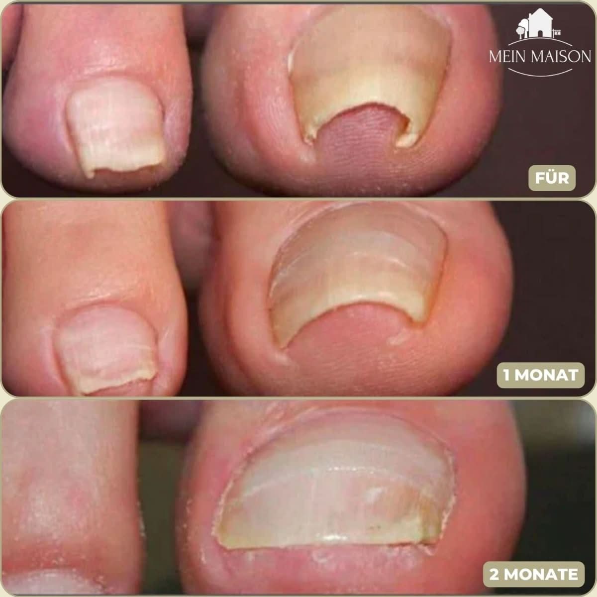 BowLift | Gentle nail correction against ingrown nails & pain