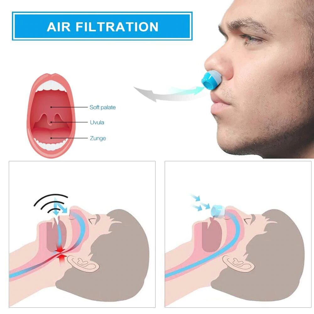 BowLift | Anti-Snoring Device | Tubeless, maskless micro-CPAP