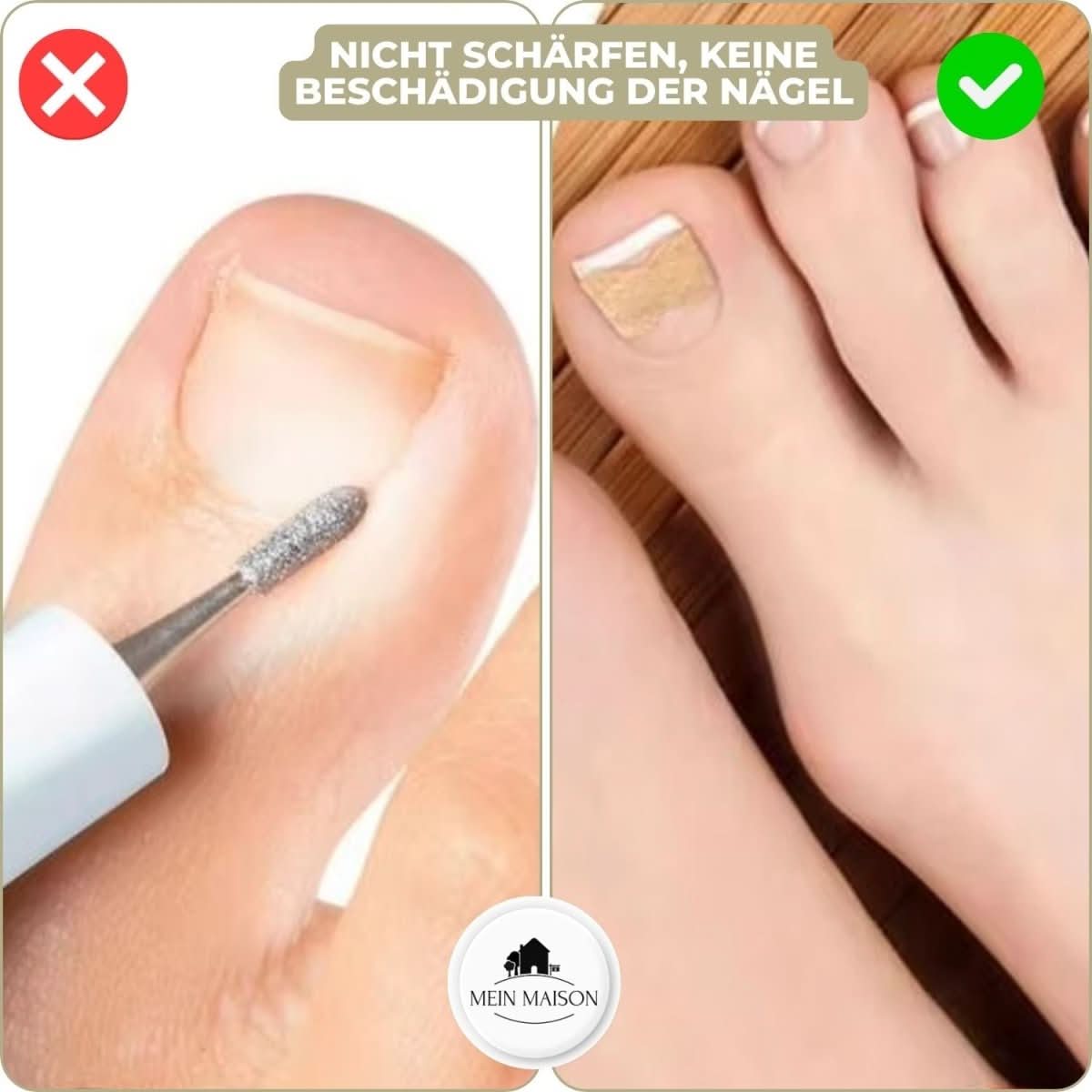 BowLift | Gentle nail correction against ingrown nails & pain