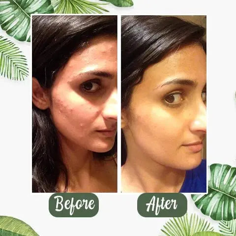 BowLift | Green Tea Deep Cleansing Mask – Against Sebum, Dirt & Clogged Pores