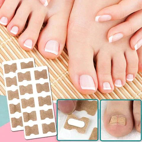 BowLift | ALIGNSTRIP – Painless Nail Correction Strips for Ingrown & Deformed Nails