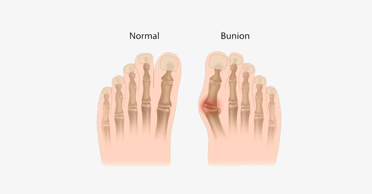 BowLift | Comfort Healing Toe Separators and Hallux Valgus Spacers